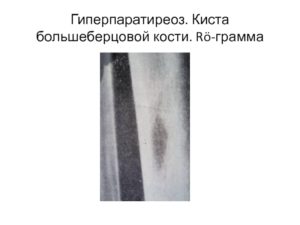 Киста большеберцовой кости у девочки 13 лет