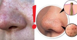 Как справится с жиром на носу?