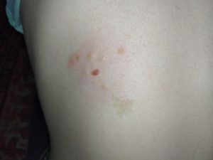 Болячка чешется