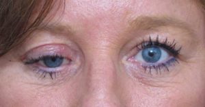 Перелом орбиты глаза