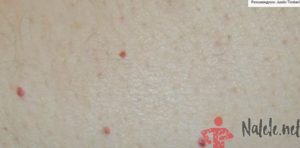 Маленькие красные точки на теле
