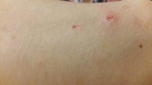 Красные прыщики на ноге