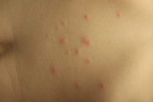 Локальные прыщи на правом боку