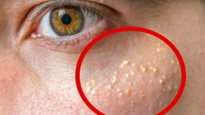 Как избавиться от милиумов на лице в домашних условиях