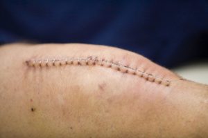 Болит послеоперационный шов