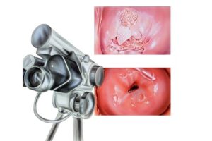 Лейкоплакия вульвы