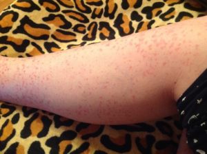 Красная сыпь на ноге