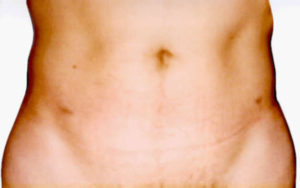 Келоидный рубец после операции паховый грыжи