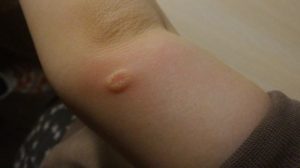 Маленький круглый чуть-чуть выпуклый бугорок