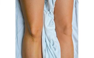 Колено ушло внутрь и встало на место