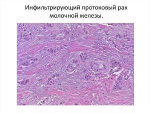 Инфильтративная дуктальная карценома