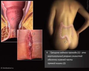 Кровь из анального отверстия после тренировок по бодибилдингу