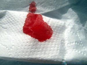 Кровянистые выделения при лечении свечами Макмирор