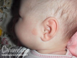 Красное шершавое пЯтно около уха, сыпь на щечках