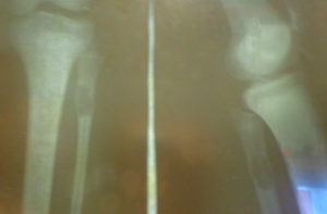 Киста большеберцовой кости у девочки 13 лет