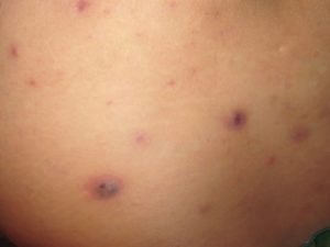 Локальные прыщи на правом боку