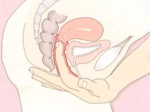 Матка низко