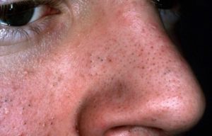 Большое количество прыщей и угрей