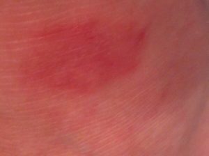 Красные пятна и боль