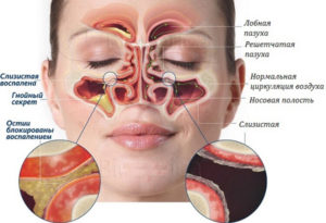 Изменение вкуса после гайморита