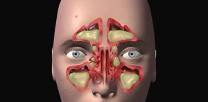 Хронический гайморит