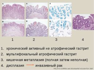 Кишечная метаплазия, эрозивно-язвенный дефект