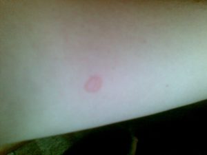 Красные, круглые пятна на руке, небольшие