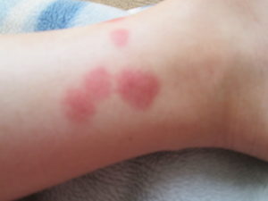 Красные, круглые пятна на нонах и руках, не чешутся