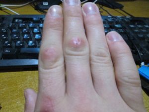 Красные мягкие шишки возле суставов пальца