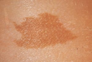 Кофейные пятна пигментация у ребенка