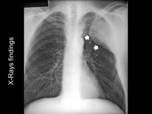 Перибронхиальный отек