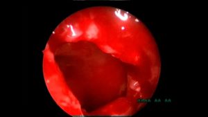 Кровь после гайморотомии