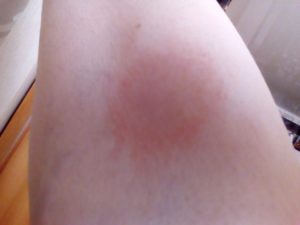 Красные пятна с уплотнением чешутся (шишки)