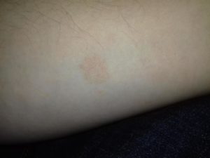 Красные, круглые пятна на руке, небольшие