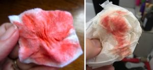 Имплантационное кровотечение и простуда