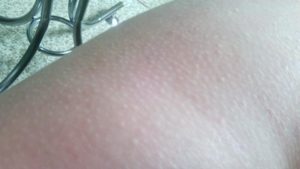 Мелкие бесцветные пупырышки на коже зимой их нет