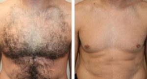 Лазерная эпиляция и волосы на груди