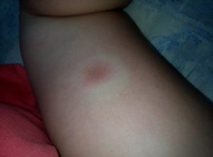 Красные пятна с уплотнением чешутся (шишки)