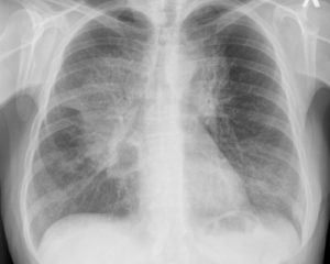 Кашель, рентген