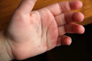 Красные ладошки, не проходящий зуд у ребенка