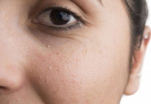 Как избавиться от милиумов на лице в домашних условиях