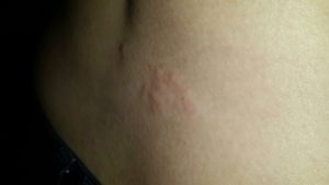 Локальные прыщи на правом боку