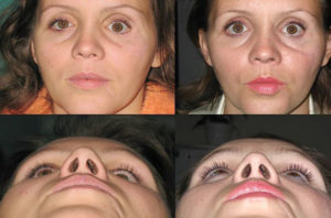 Перелом орбиты глаза