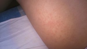 Красные прыщики на ляжках