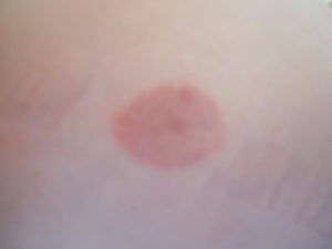 Красное пятно на коже увеличилось