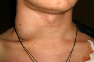 Лимфоузлы при кариесе