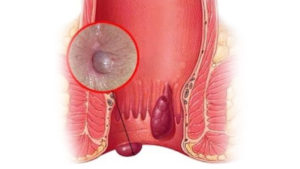 Кровь из анального отверстия после тренировок по бодибилдингу