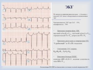 Кардиотренировка, расшифровка экг