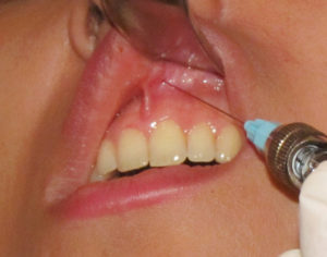 Болит и опухла десна после укола анестезии