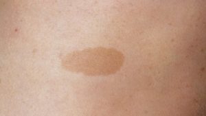 Кофейные пятна пигментация у ребенка